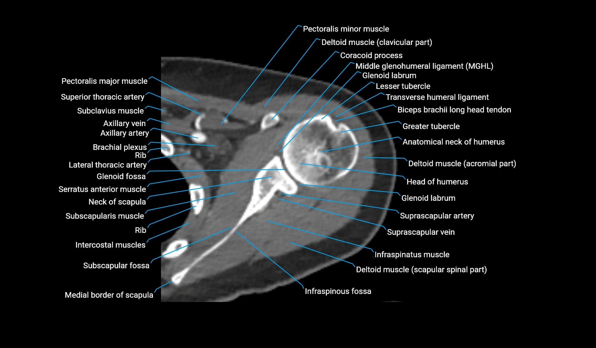 CT upper arm axial  cross sectional anatomy labelled radiology image -00092.webp